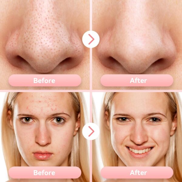 Blackhead Remover Pore Vacuum Upgraded Facial Pore Cleaner Electric Comedone Whitehead Extractor Tool-5 Suction Power,5 Probes,USB Rechargeable Blackhead Vacuum Kit for Women & Men - Image 6